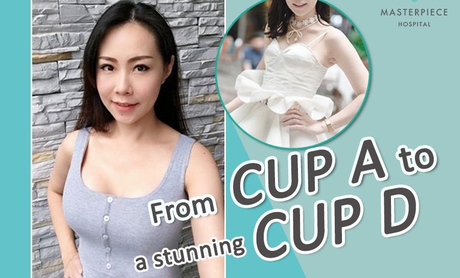 Breast Augmentation changed me from Cup A to a stunning Cup D
