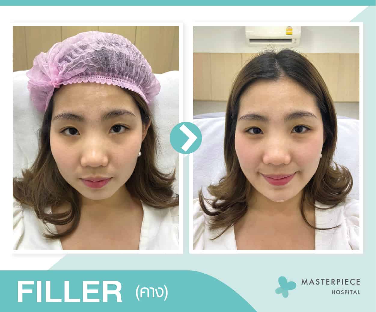 รีวิวฟิลเลอร์คางช่วยปรับรูปหน้า หน้าเรียว หน้าเล็ก หน้าเข้ารูป filler คางช่วยได้