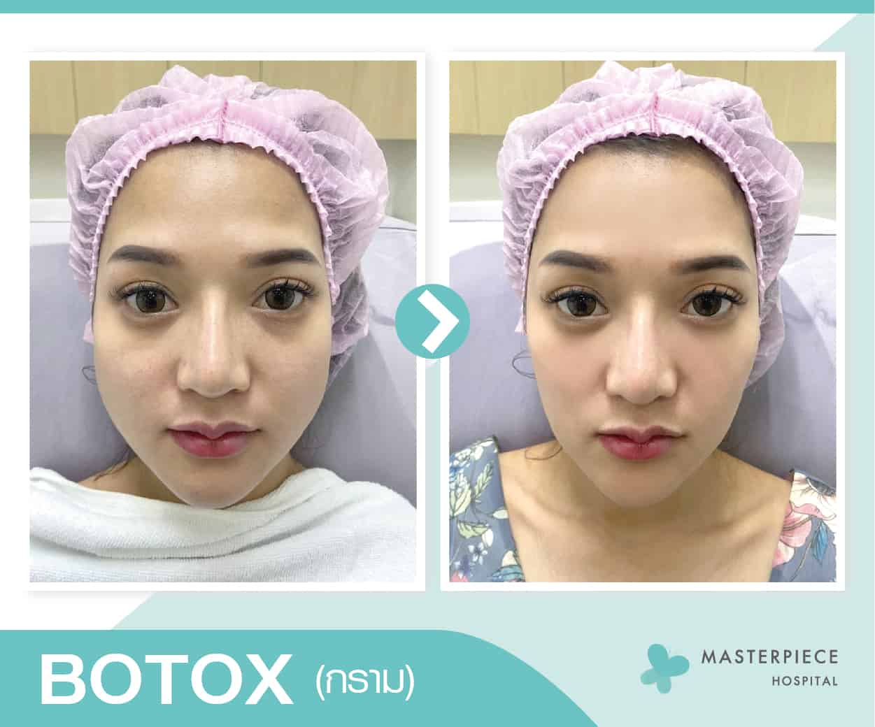 รีวิวก่อนและหลังทำ Botox กรามเล็กลงอย่างเ็นได้ชัด