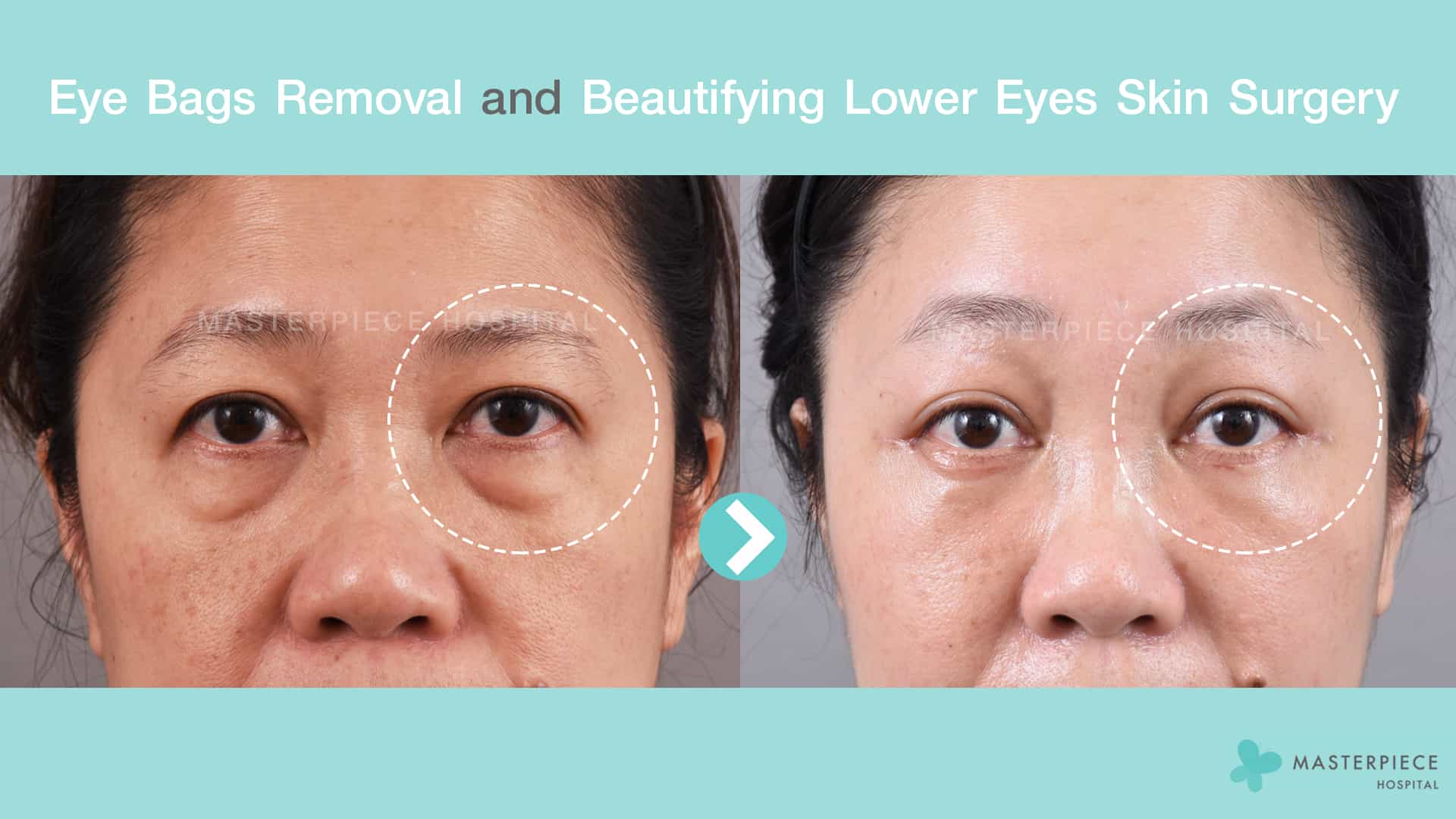 39 Best Eye Bag Removal in Kuala Lumpur - Price Guide & Reviews