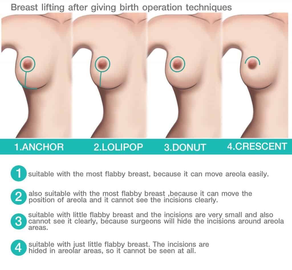 Can I Get A Breast Lift After Breastfeeding?