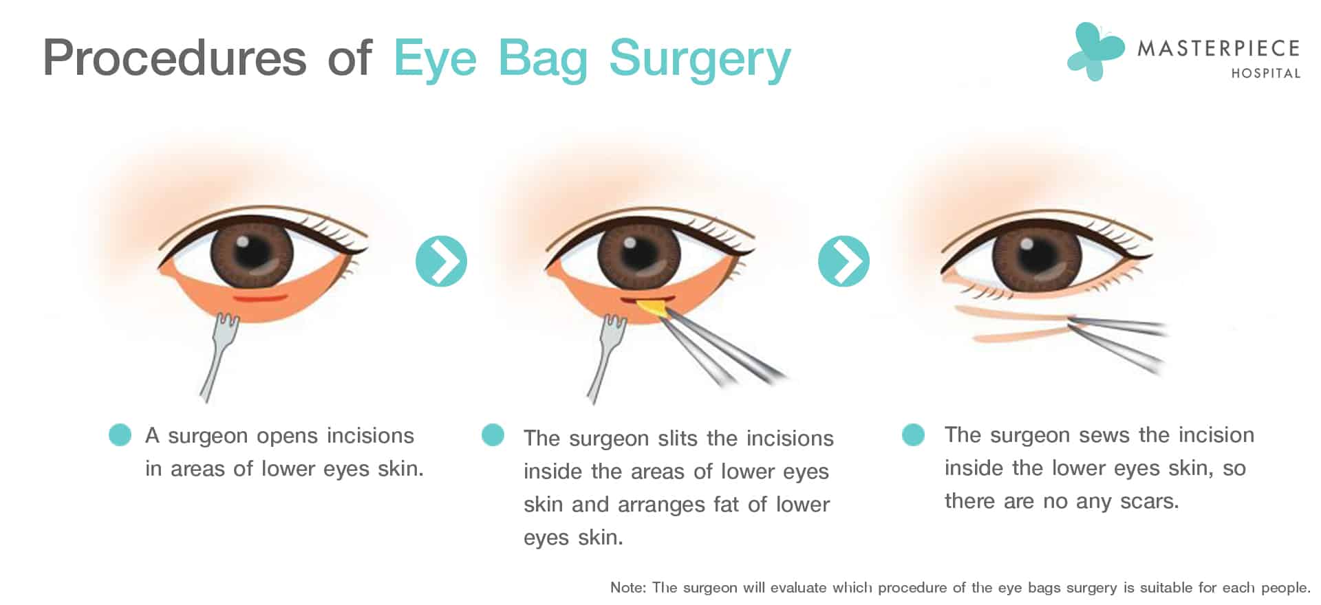 Eye Bags surgery Masterpiece Hospital