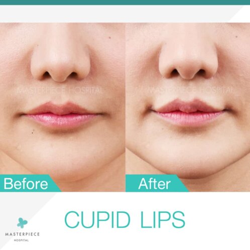 Cupid Lips - Masterpiece Hospital