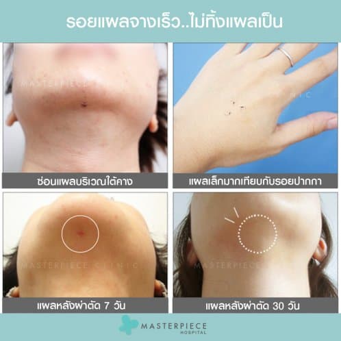 ดูดไขมันหน้า Facial Vaser Liposuction - Masterpiece Hospital