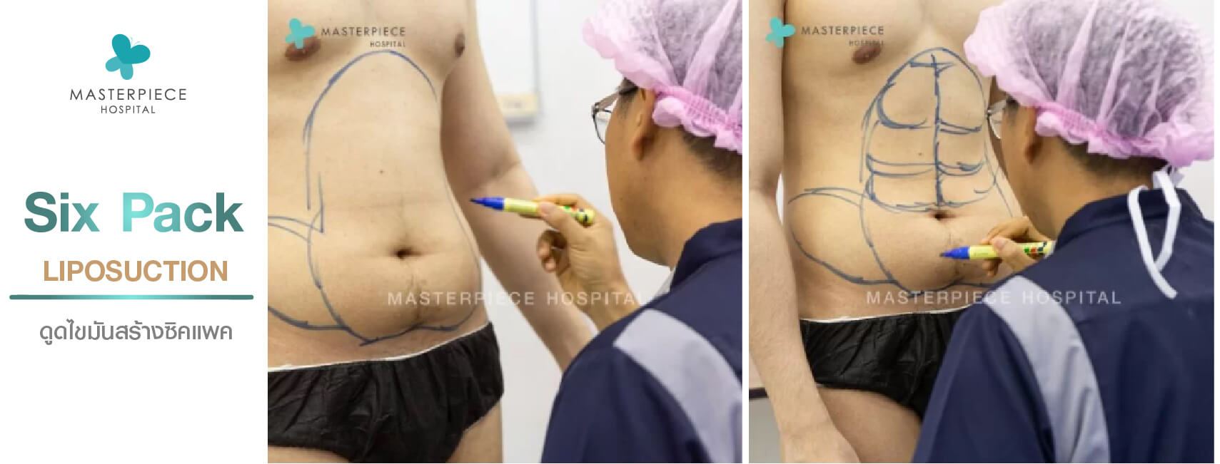 six pack liposuction แพทย์จะทำการวางแผนการทำหัตถการก่อนลงมือ เพื่อผลัพธ์ที่ดีที่สุด