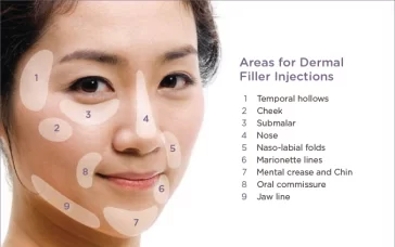 ตำแหน่งการฉีด filler เพื่อหวังผลการลดริ้วรอยในจุดต่าง ๆ บนใบหน้า