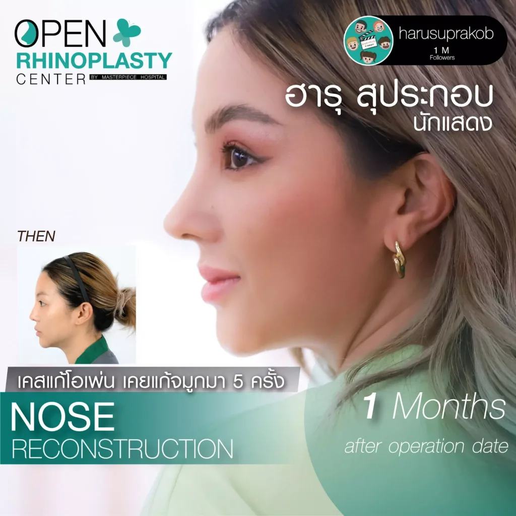 NoseCorrectionSurgery1