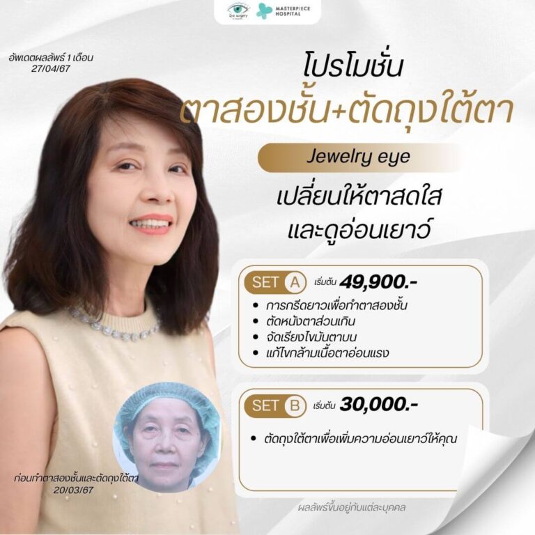 โปรโมชั่นทำตาสองชั้นและตัดถุงใต้ตา โรงพยาบาลมาสเตอร์พีช ศัลยกรรมตาเพื่อดวงตาที่สดใส