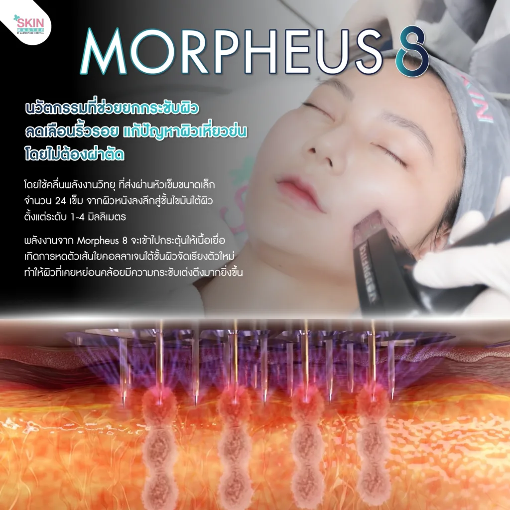 Morpheus8 นวัตกรรมที่ช่วยยกกระชับผิว ลบเลือนริ้มรอย แก้ปัญหาผิวเหี่ยวย่น