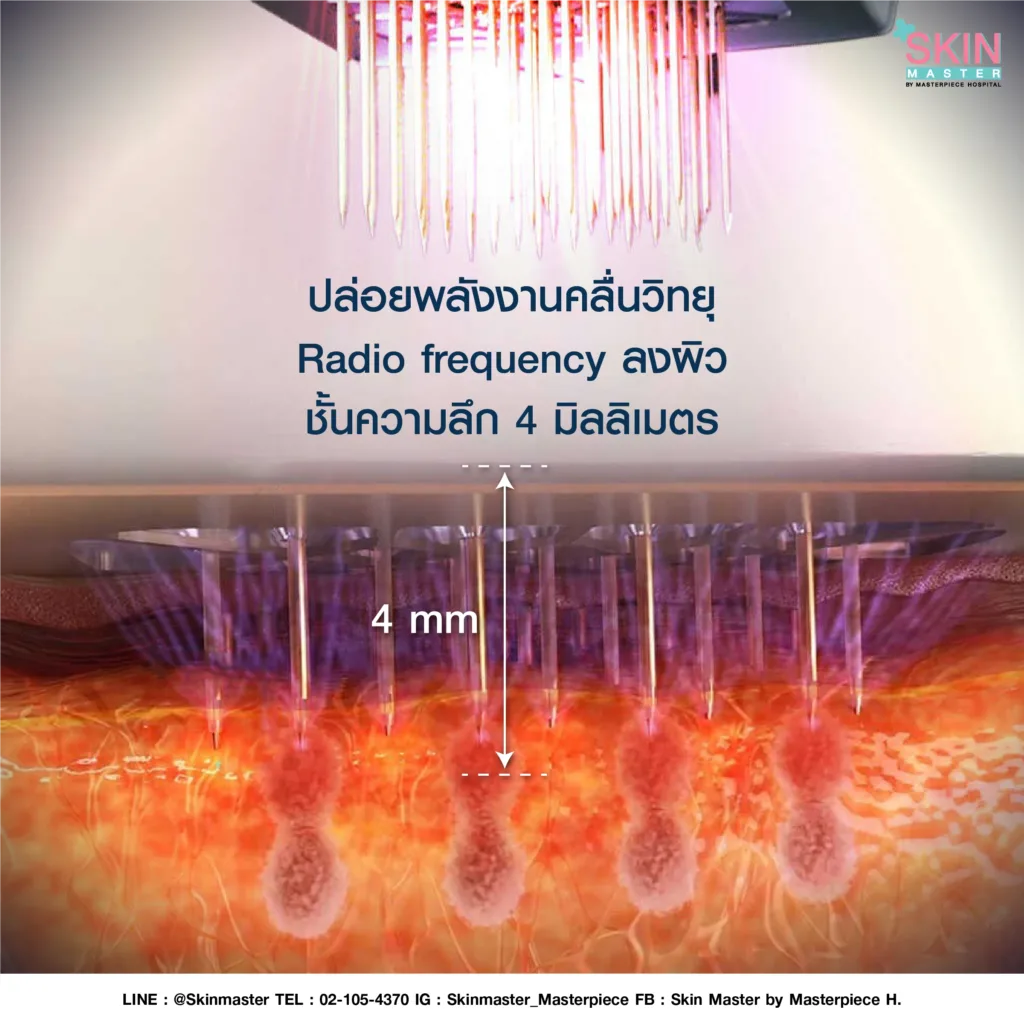 ปล่อยพลังงานคลื่นวิทยุ Radio frequency ลงผิว