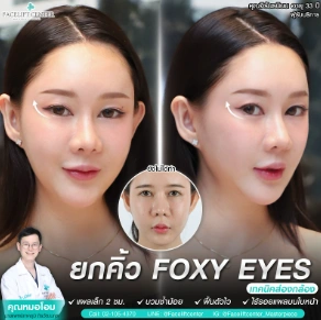 เทคนิคส่องกล้อง ยกคิ้ว foxy Eyes