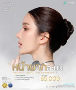 โปรโมชั่นเดือนตุลคม หน้าผากละมุน 65000 รีวิวผู้หญิงหันข้าง