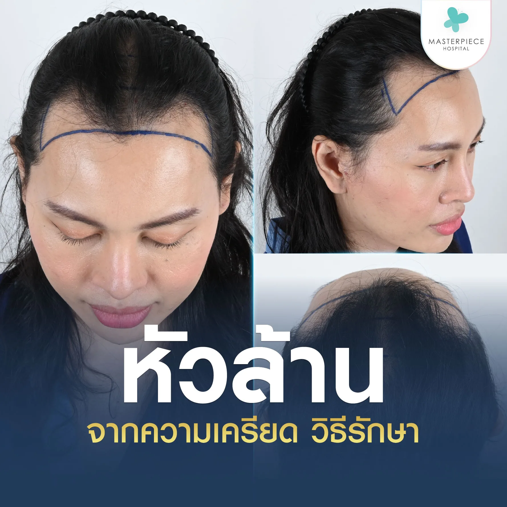 หัวล้าน